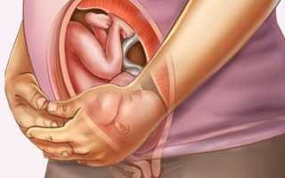 Как долго (быстро) рассасывается гематома при беременности