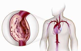 Как лечить аневризму аорты грудного отдела и ее симптомы