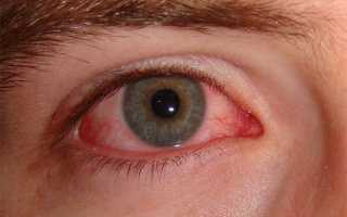 Гиперемия конъюнктивы (венозное полнокровие) глазного дна яблока