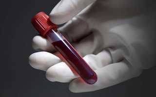 Что такое гемолиз эритроцитов при сдаче анализов крови