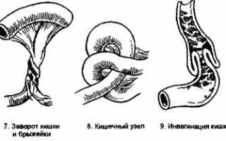 Лечение непроходимости кишечника народными средствами