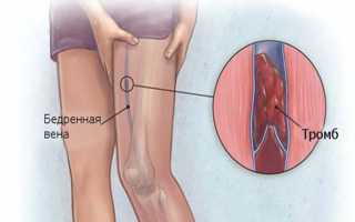 Как лечить острый илеофеморальный тромбоз нижних конечностей