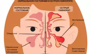 Гайморит при беременности
