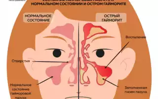 Гайморит при беременности