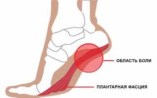Пяточная шпора