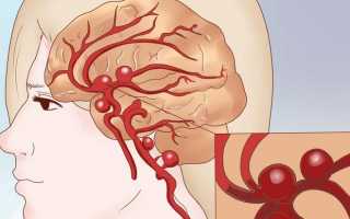 Как лечить закупорку (тромбоэмболию) сосудов головного мозга и какие симптомы эмболии мозговых артерий