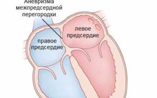 Как лечить аневризму межпредсердной (межжелудочковой) перегородки (МПП) сердца у взрослых и детей