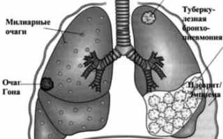 Туберкулез легких – лечение народными средствами