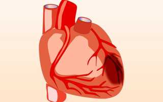Как лечить умеренную гипоксию миокарда (кислородное голодание сердца) и какие у нее симптомы