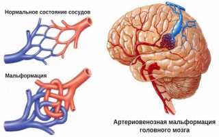 Как лечить артериовенозную мальформацию сосудов головного мозга и симптомы артериально-венозной