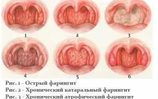 Формы, диагностика, лечение фарингита у взрослых