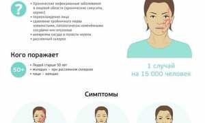 Неврит тройничного нерва: симптомы и лечение