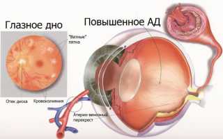 Как лечить гипертоническую ангиопатию сосудов сетчатки глаза и какие ее признаки