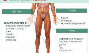 Подагра: признаки и лечение