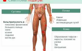 Подагра: признаки и лечение