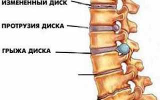 Радикулит, лечение народными средствами