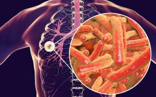 Особенности развития туберкулезной гранулемы и методы ее лечения