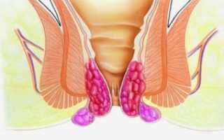 Как проводят тромбэктомию наружного геморроидального узла (удаление тромба) при беременности