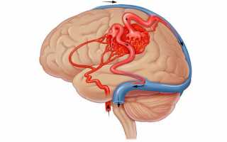 Как лечить церебральный вазоспазм сосудов головного мозга и какие его признаки
