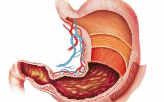 Что такое поверхностный гастрит и чем лечить