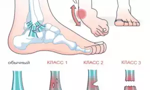 Растяжение голеностопа: симптомы и лечение