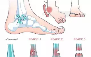 Растяжение голеностопа: симптомы и лечение