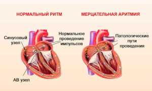 Аритмия сердца: что делать и как лечить