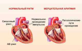 Аритмия сердца: что делать и как лечить
