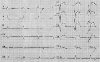 Признаки инфаркта миокарда (ИМ) на ЭКГ и как выглядит расшифровка кардиограммы на различных стадиях