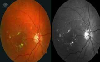 Как лечить тромбоз центральной вены (сосудов) сетчатки (ЦВС) глаза