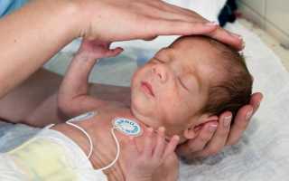 Стеноз аортального клапана (сужение аорты) сердца у новорожденных детей