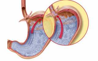 Что такое билиарный рефлюкс гастрит и какие симптомы заболевания