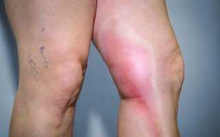 Как лечить тромбоз подколенной вены (артерии) и симптомы тромба коленного сустава