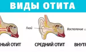Лечение отита у взрослых: причины, осложнения, терапия и профилактика