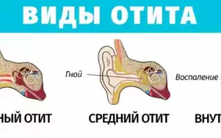 Лечение отита у взрослых: причины, осложнения, терапия и профилактика