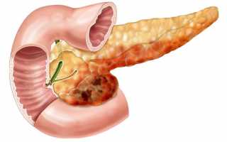 Что такое некроз поджелудочной железы