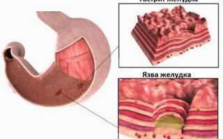 Какие симптомы с признаками гастрита и отличия от язвы желудка