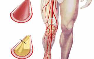 Как лечить сужение сосудов нижних конечностей и какие симптомы стеноза артерий (вен) на ногах