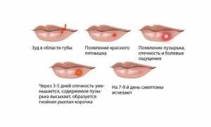 Как лечить герпес на губах?