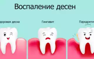 Как облегчить и снять зубную боль до визита к стоматологу?