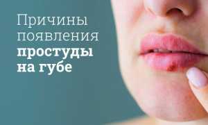 Простуда на губах: причины и лечение