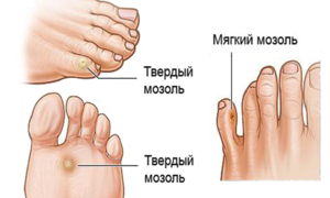 4 способа лечения сухой мозоли между пальцами ног