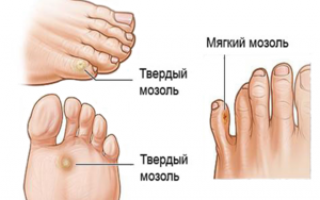 4 способа лечения сухой мозоли между пальцами ног