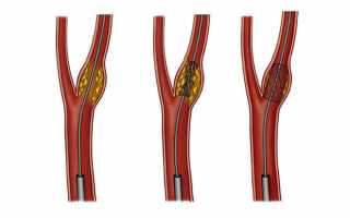 Как лечить стеноз правой сонной артерии и какие симптомы сужения