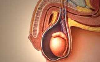 Лечение водянки яичка народными средствами