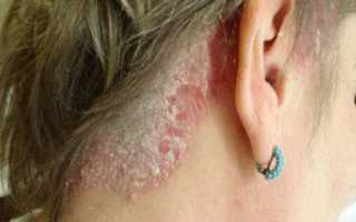 Лечение кожи головы народными средствами