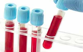 Что значат понижены лейкоциты в анализе крови у женщин (причины низкого уровня)