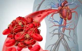 Что делать при тромбозе сердца и от чего может оторваться тромб (внутрисердечный)