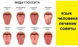 Глоссит: причины, симптомы и лечение