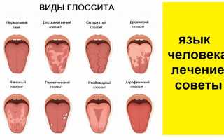 Глоссит: причины, симптомы и лечение